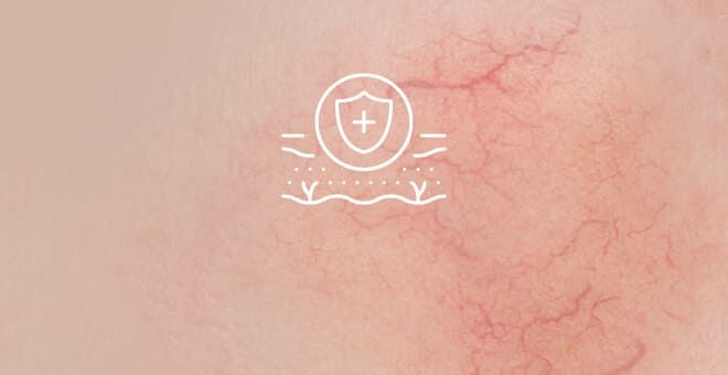 Skizze von Couperose mit roten Äderchen  durchzogener Haut