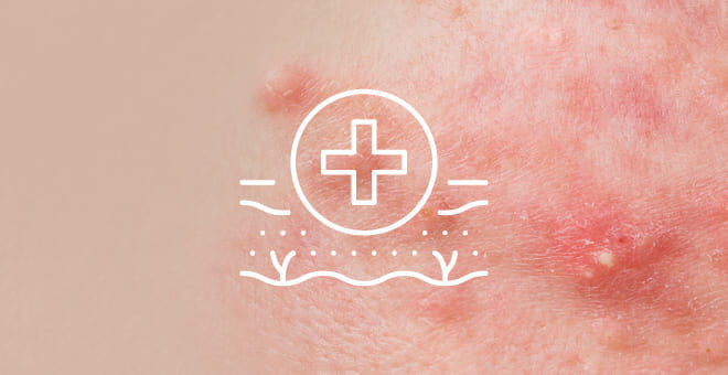 Das Hautbild Rosacea kennzeichnet eine gerötete Haut, mit sichtbar erweiterten Äderchen in Kombination mit Pickelchen und Pickeln, die mal mehr und mal weniger stark in Schüben auftreten