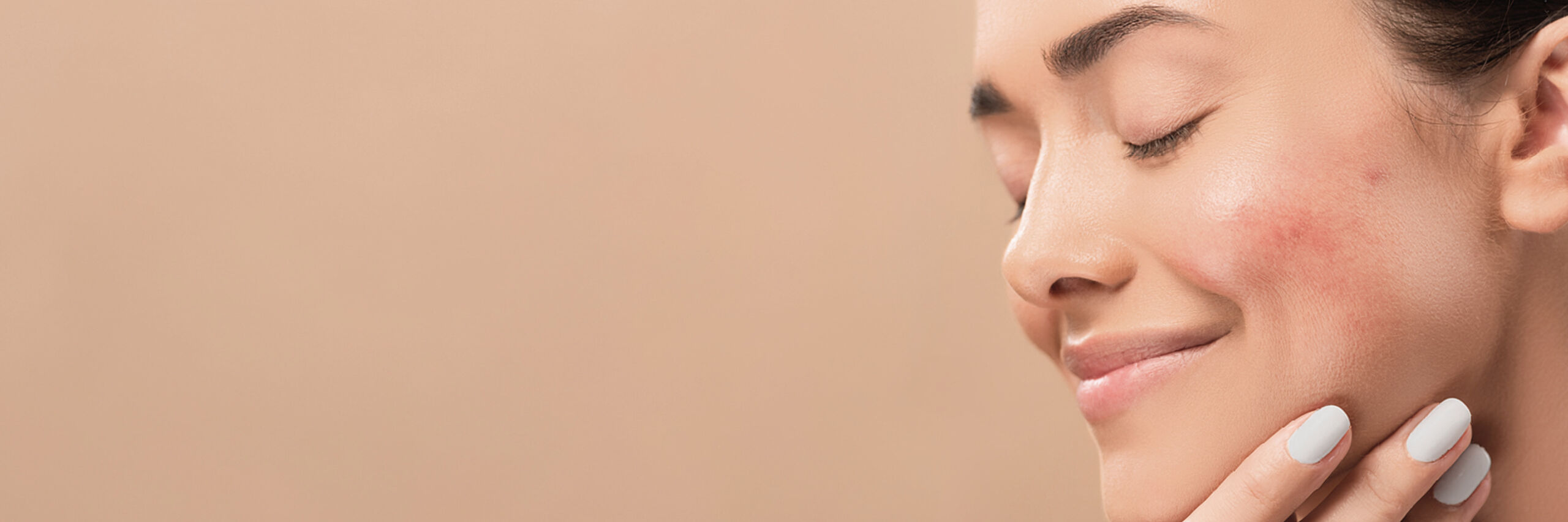 Frau mit Rosacea
